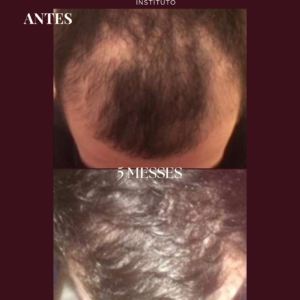 Photobiomodulation cheveux - Jouvence Instituto