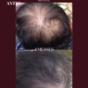 Photobiomodulation cheveux - Jouvence Instituto