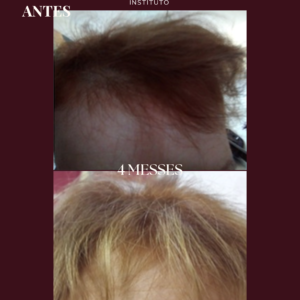 Photobiomodulation cheveux - Jouvence Instituto