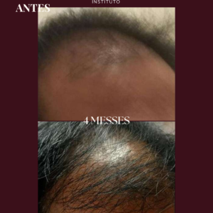 Photobiomodulation cheveux - Jouvence Instituto
