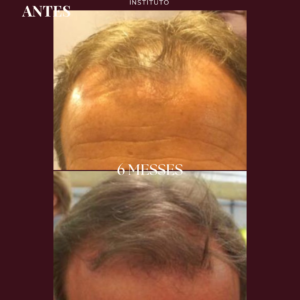 Photobiomodulation cheveux - Jouvence Instituto