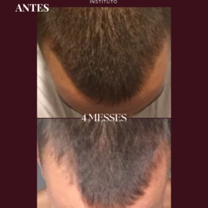 Photobiomodulation cheveux - Jouvence Instituto
