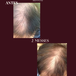 Photobiomodulation cheveux - Jouvence Instituto